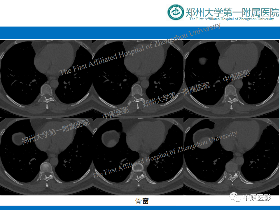 影像PPT - 【病例】脊柱胸椎腱鞘巨细胞瘤1例CT及MR-11