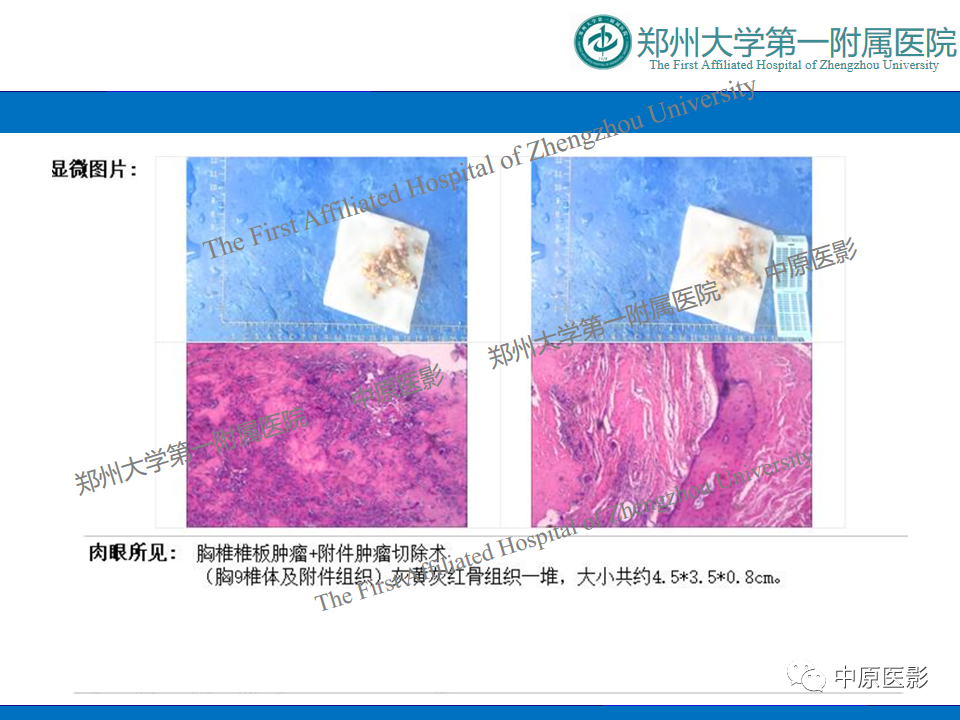 影像PPT - 【病例】脊柱胸椎腱鞘巨细胞瘤1例CT及MR-2