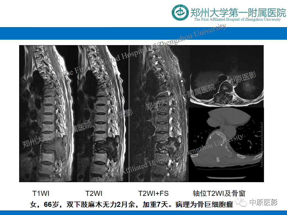 影像PPT - 【病例】脊柱胸椎腱鞘巨细胞瘤1例CT及MR-12