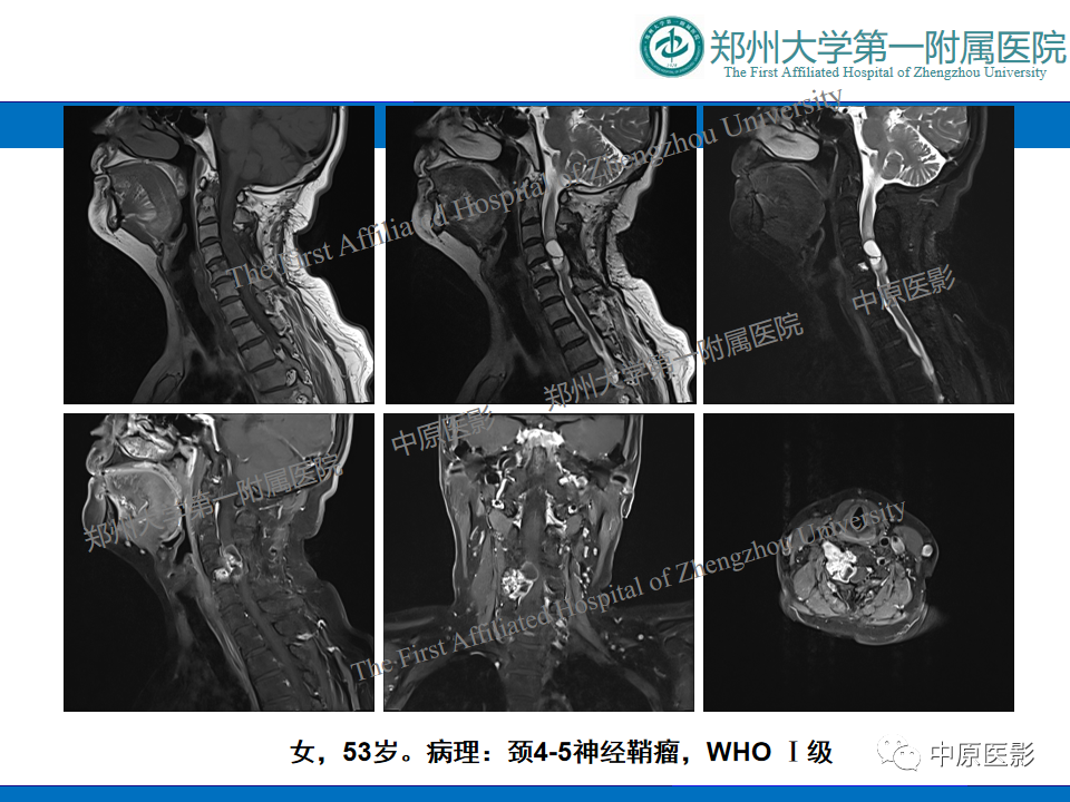 影像PPT - 【病例】脊柱胸椎腱鞘巨细胞瘤1例CT及MR-15