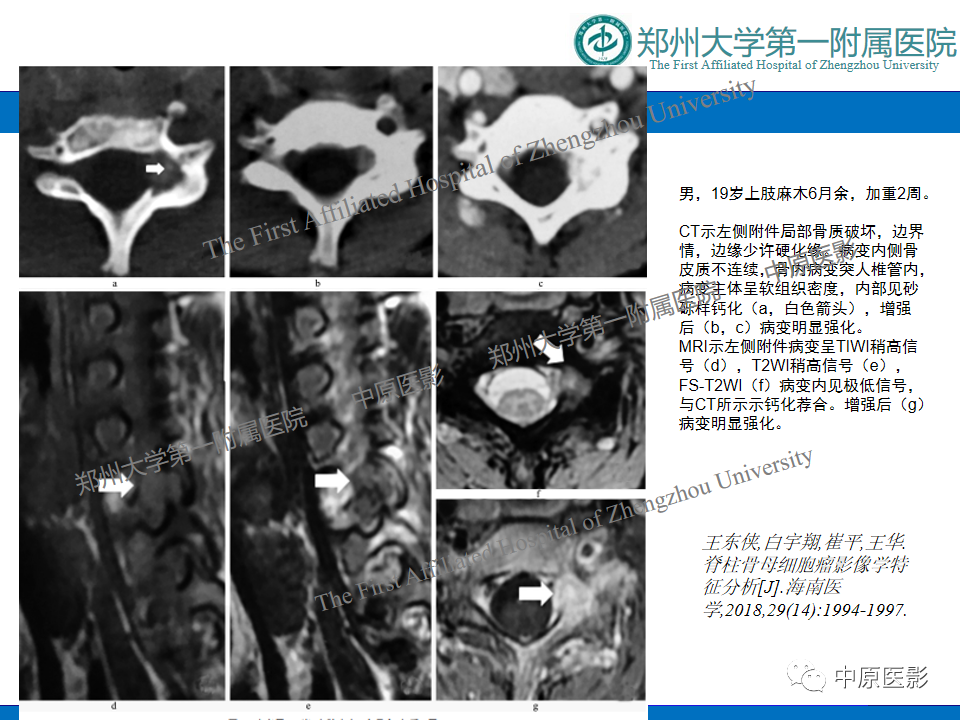 影像PPT - 【病例】脊柱胸椎腱鞘巨细胞瘤1例CT及MR-17