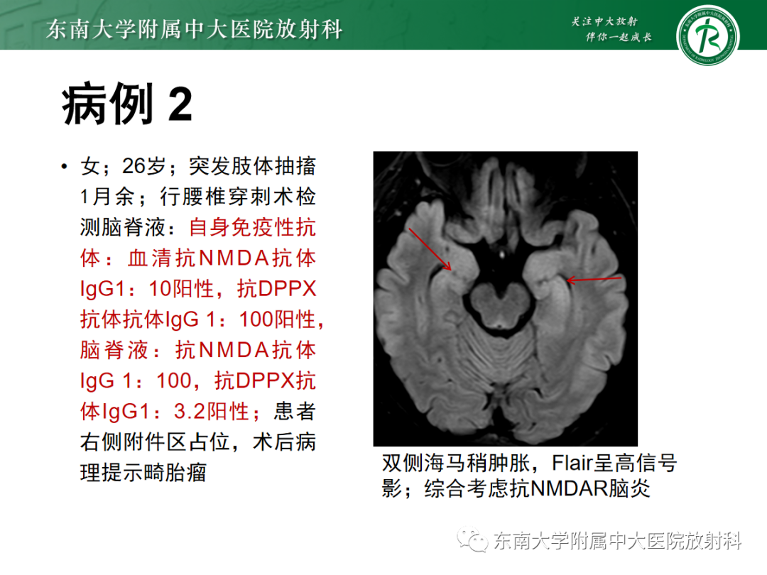 影像PPT - 【PPT】自身免疫性脑炎-15