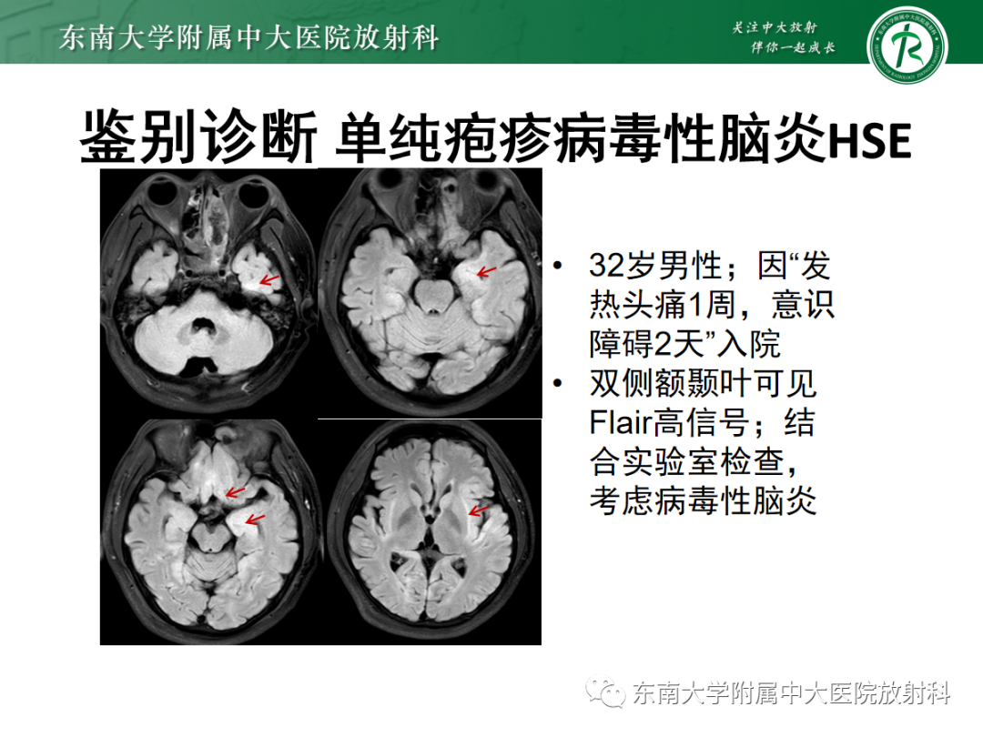 影像PPT - 【PPT】自身免疫性脑炎-23