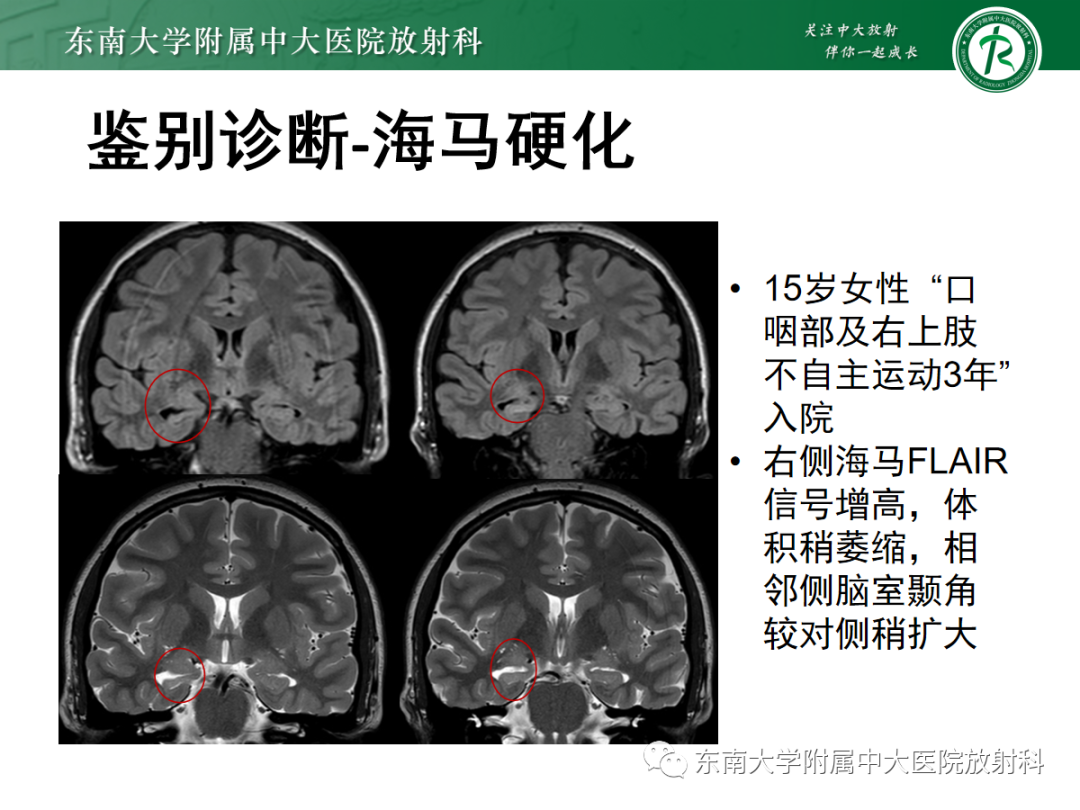 影像PPT - 【PPT】自身免疫性脑炎-25