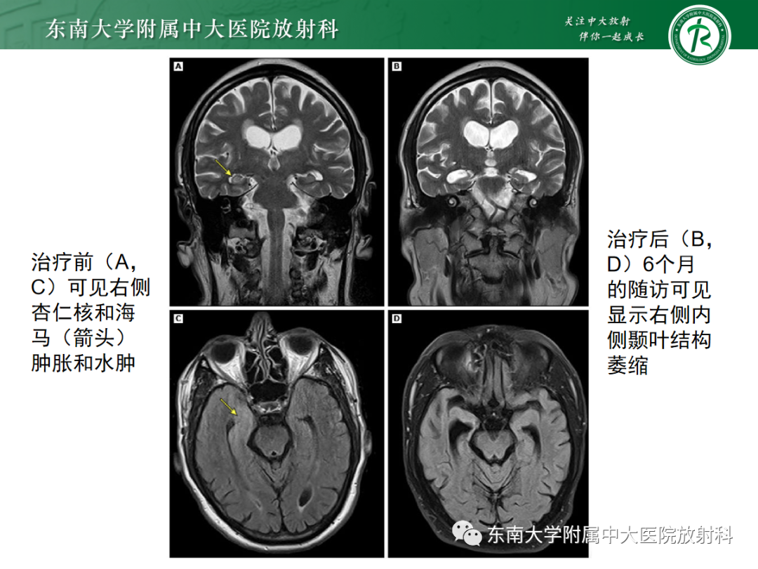 影像PPT - 【PPT】自身免疫性脑炎-28