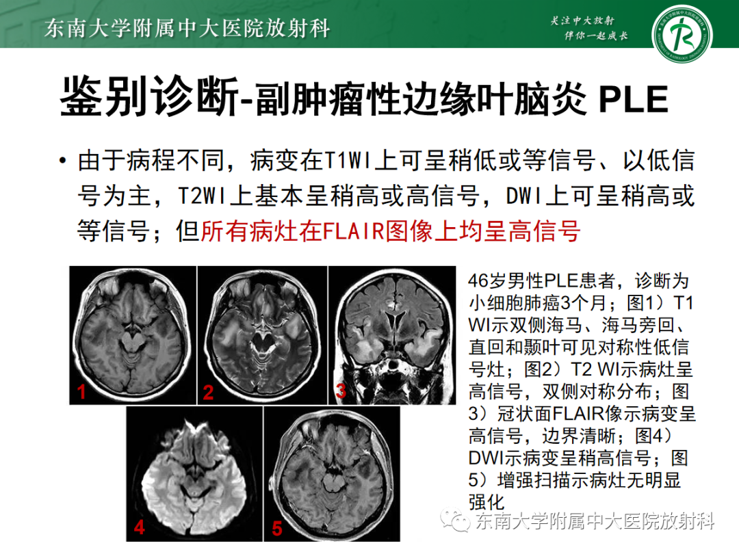 影像PPT - 【PPT】自身免疫性脑炎-30