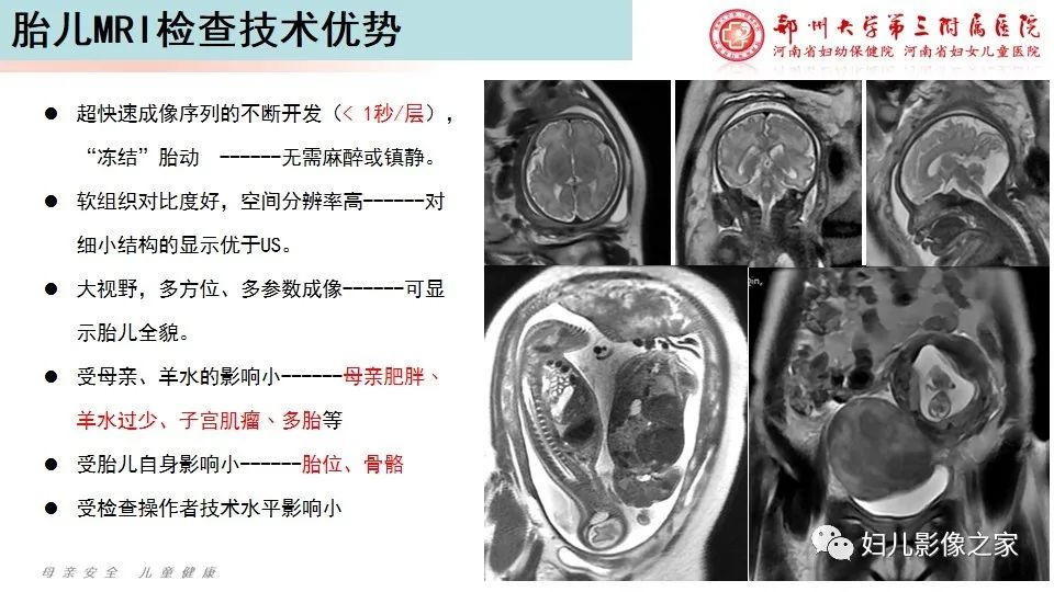 影像PPT - 【PPT】胎儿脉管畸形的影像诊断-5