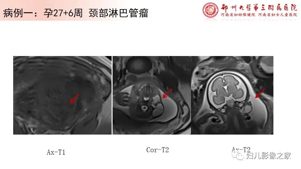 影像PPT - 【PPT】胎儿脉管畸形的影像诊断-12