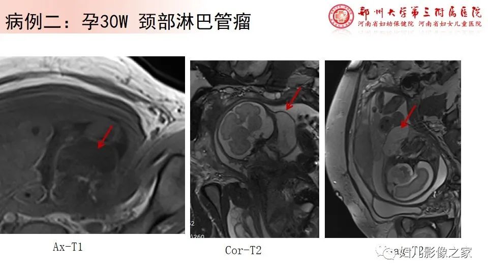 影像PPT - 【PPT】胎儿脉管畸形的影像诊断-14