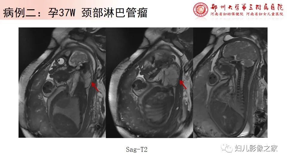 影像PPT - 【PPT】胎儿脉管畸形的影像诊断-15