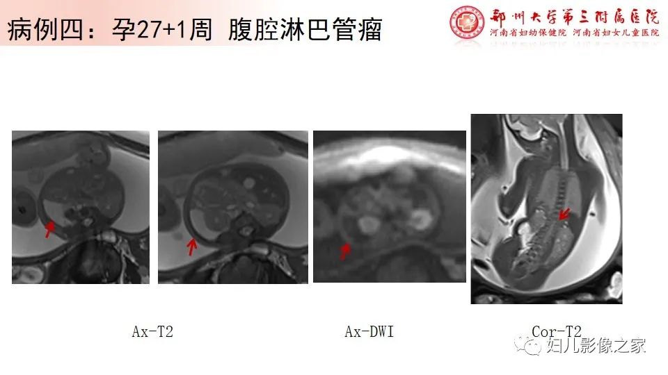 影像PPT - 【PPT】胎儿脉管畸形的影像诊断-17