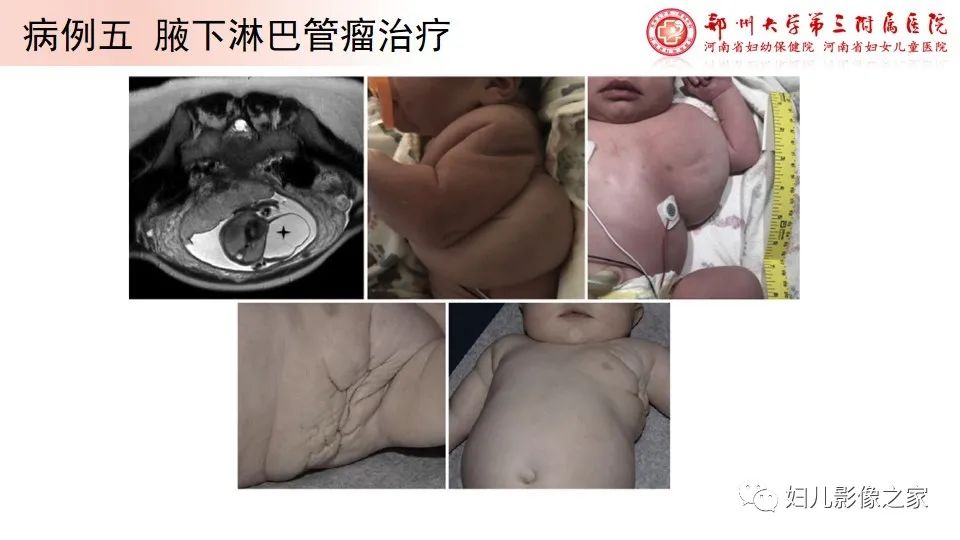 影像PPT - 【PPT】胎儿脉管畸形的影像诊断-18