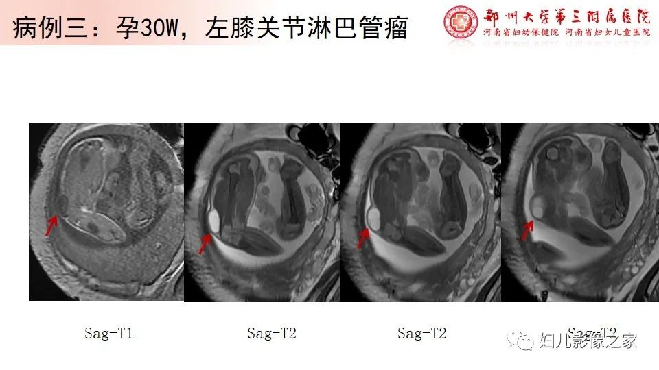 影像PPT - 【PPT】胎儿脉管畸形的影像诊断-16