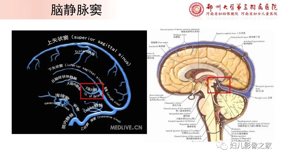 影像PPT - 【PPT】胎儿脉管畸形的影像诊断-21