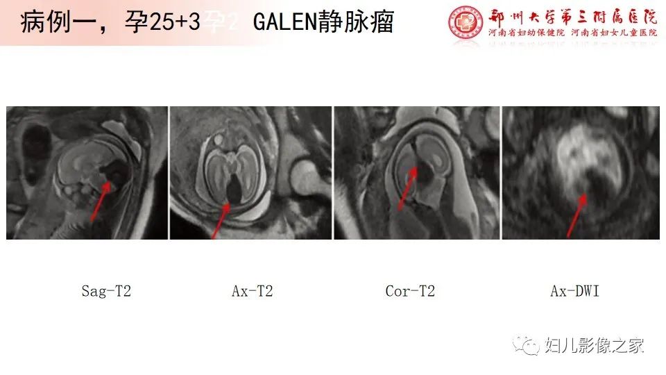 影像PPT - 【PPT】胎儿脉管畸形的影像诊断-24