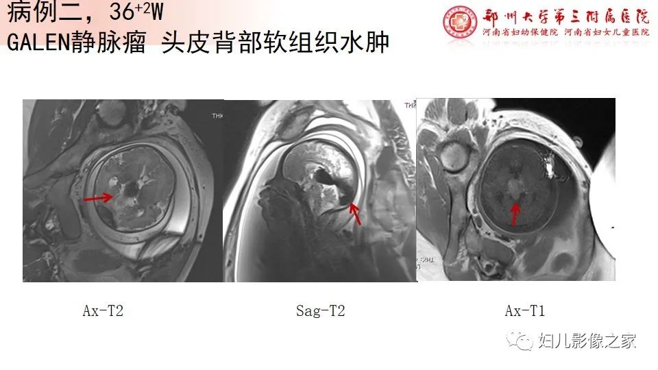 影像PPT - 【PPT】胎儿脉管畸形的影像诊断-25