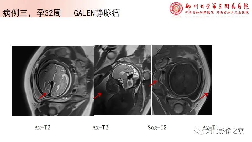 影像PPT - 【PPT】胎儿脉管畸形的影像诊断-26