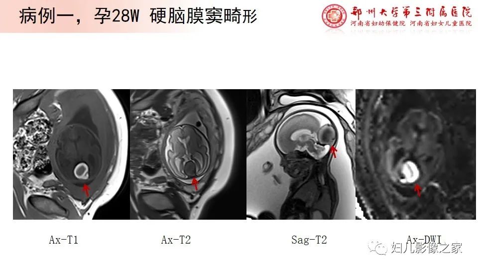 影像PPT - 【PPT】胎儿脉管畸形的影像诊断-30