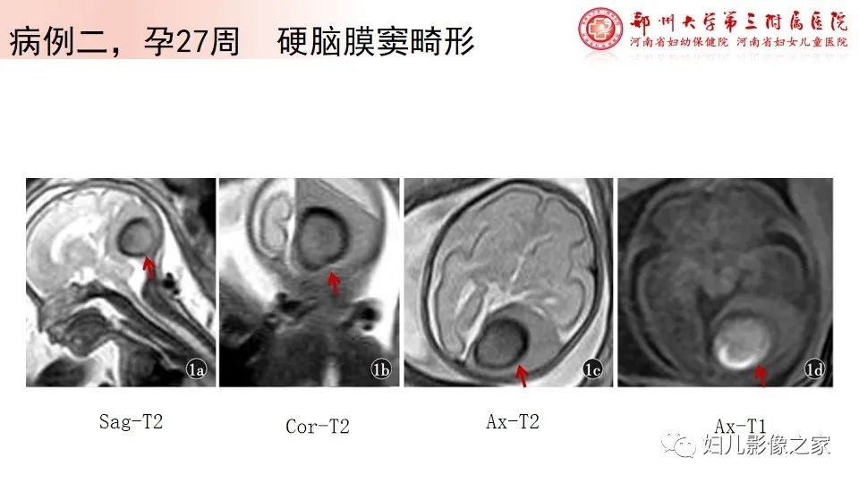 影像PPT - 【PPT】胎儿脉管畸形的影像诊断-31