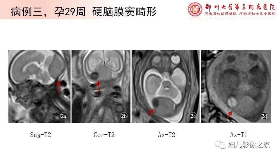 影像PPT - 【PPT】胎儿脉管畸形的影像诊断-32