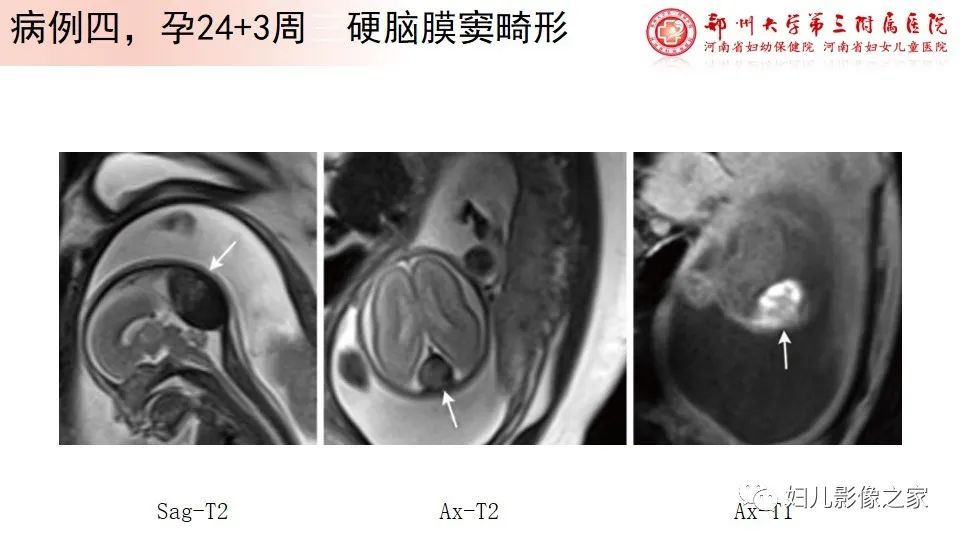 影像PPT - 【PPT】胎儿脉管畸形的影像诊断-33