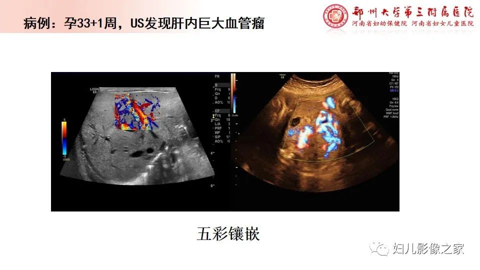 影像PPT - 【PPT】胎儿脉管畸形的影像诊断-36