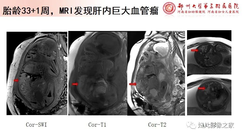 影像PPT - 【PPT】胎儿脉管畸形的影像诊断-37