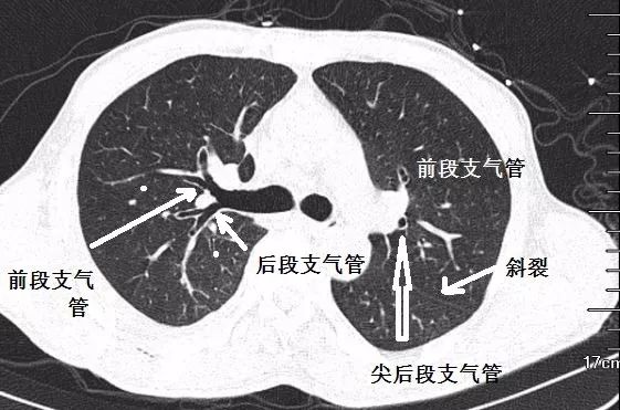 影像PPT - 支气管CT解剖-3 影像PPT - 支气管CT解剖-3