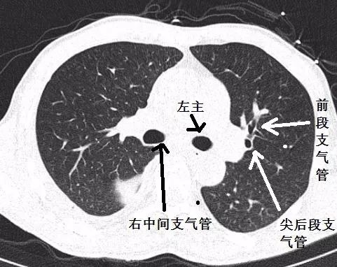 影像PPT - 支气管CT解剖-5 影像PPT - 支气管CT解剖-5