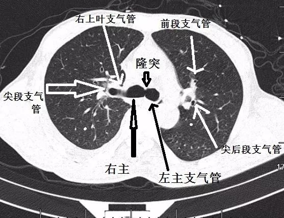 影像PPT - 支气管CT解剖-2 影像PPT - 支气管CT解剖-2