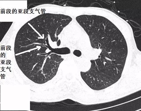 影像PPT - 支气管CT解剖-4 影像PPT - 支气管CT解剖-4