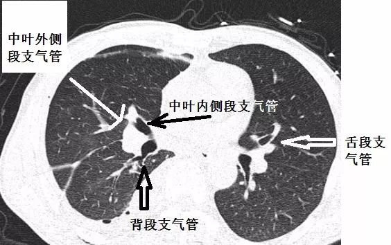 影像PPT - 支气管CT解剖-9 影像PPT - 支气管CT解剖-9