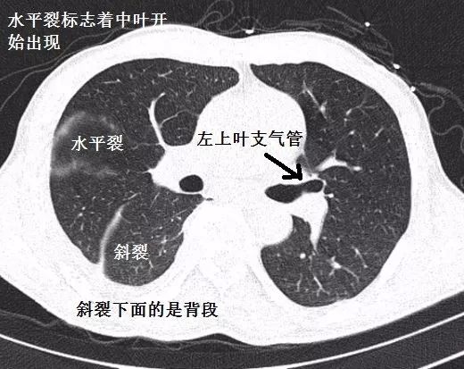 影像PPT - 支气管CT解剖-6 影像PPT - 支气管CT解剖-6
