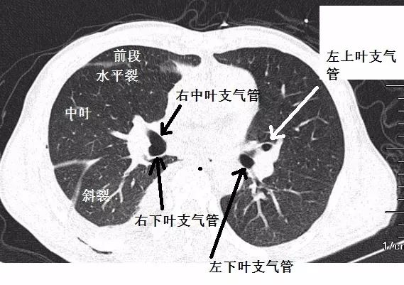 影像PPT - 支气管CT解剖-7 影像PPT - 支气管CT解剖-7