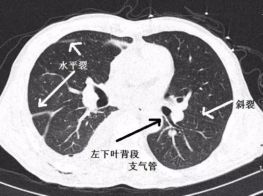 影像PPT - 支气管CT解剖-8 影像PPT - 支气管CT解剖-8
