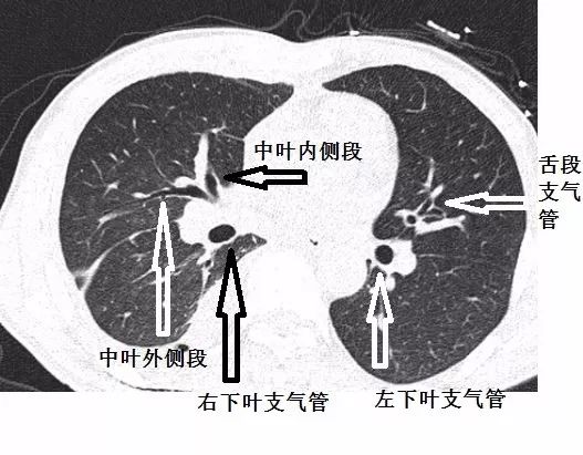 影像PPT - 支气管CT解剖-10 影像PPT - 支气管CT解剖-10