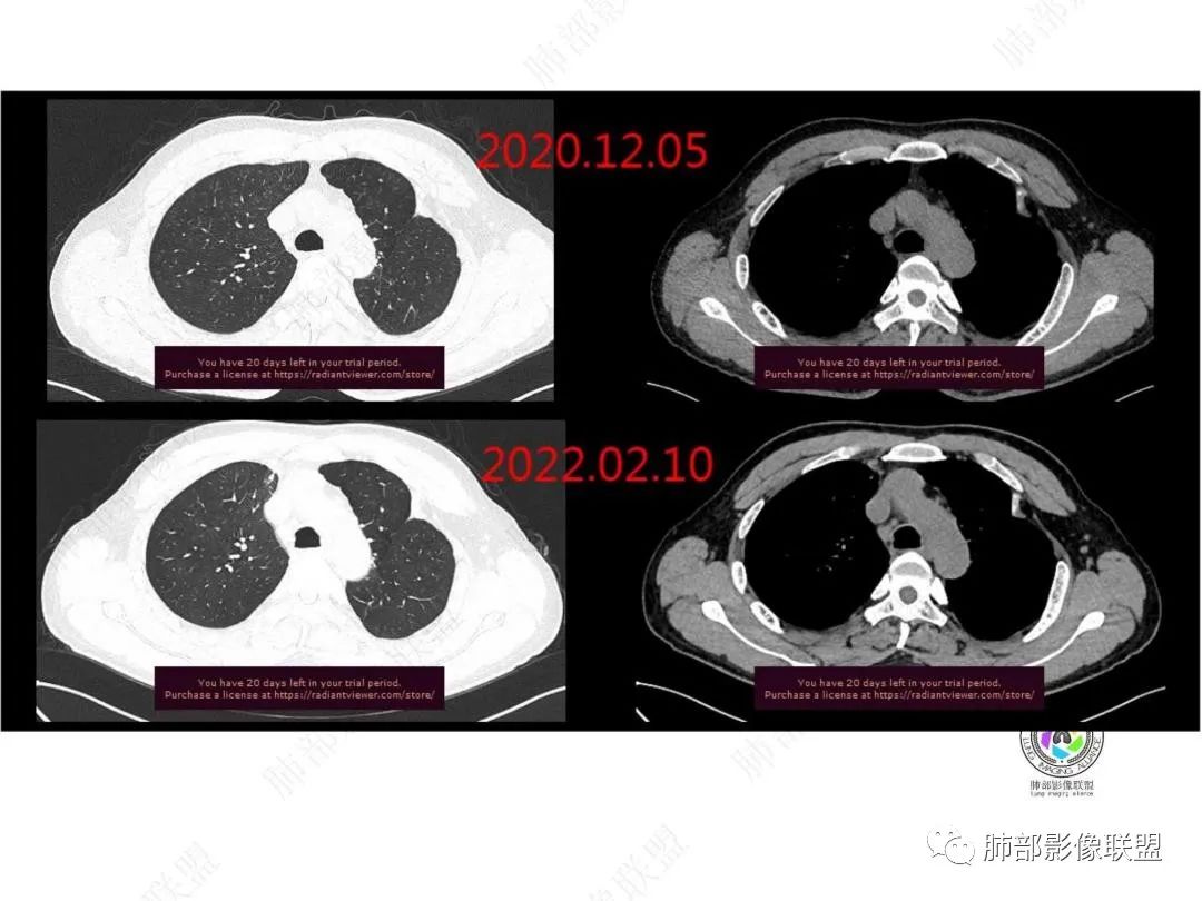 影像PPT - 【病例】右肺与肝脏病灶来袭,是否同源?-6 影像PPT - 【病例】右肺与肝脏病灶来袭,是否同源?-6
