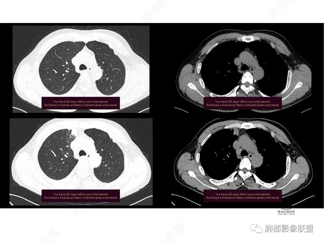 影像PPT - 【病例】右肺与肝脏病灶来袭,是否同源?-7 影像PPT - 【病例】右肺与肝脏病灶来袭,是否同源?-7