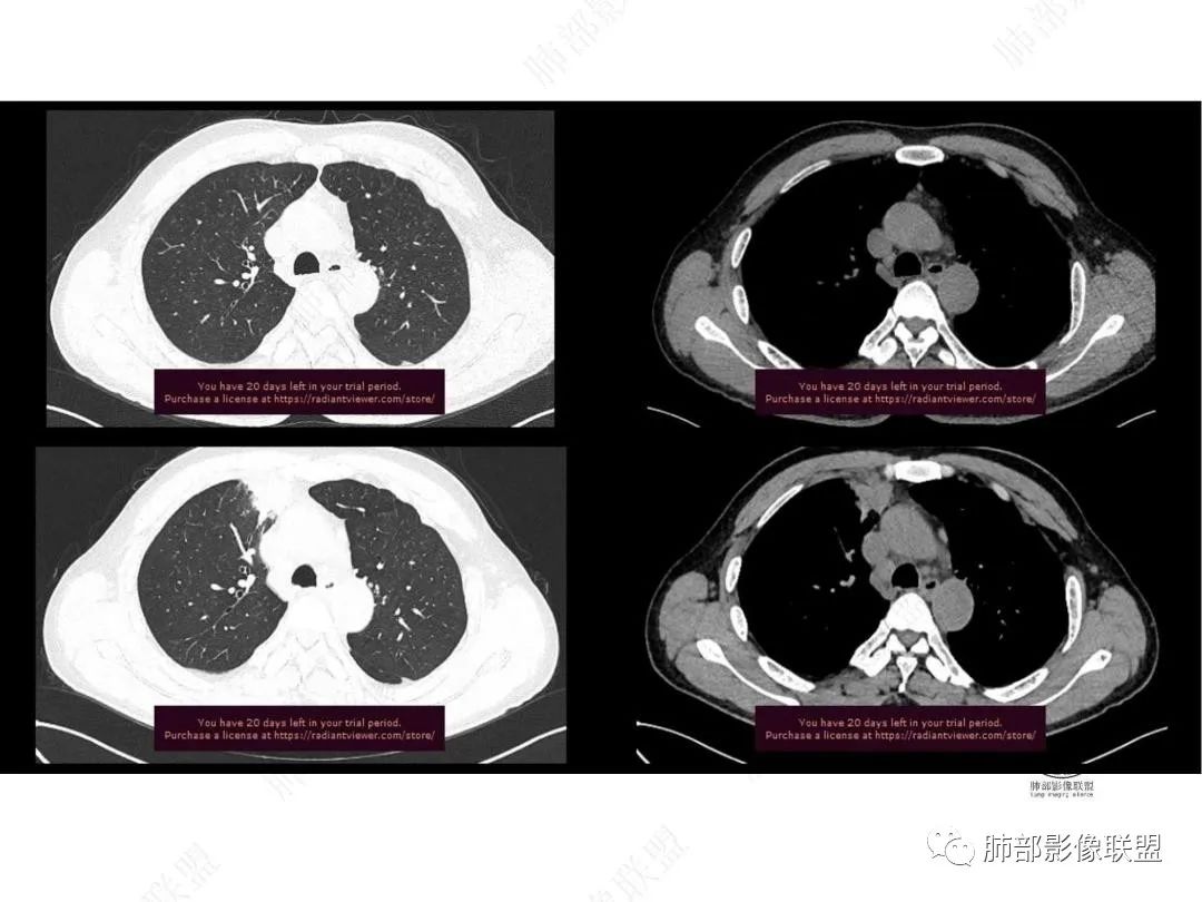 影像PPT - 【病例】右肺与肝脏病灶来袭,是否同源?-8 影像PPT - 【病例】右肺与肝脏病灶来袭,是否同源?-8