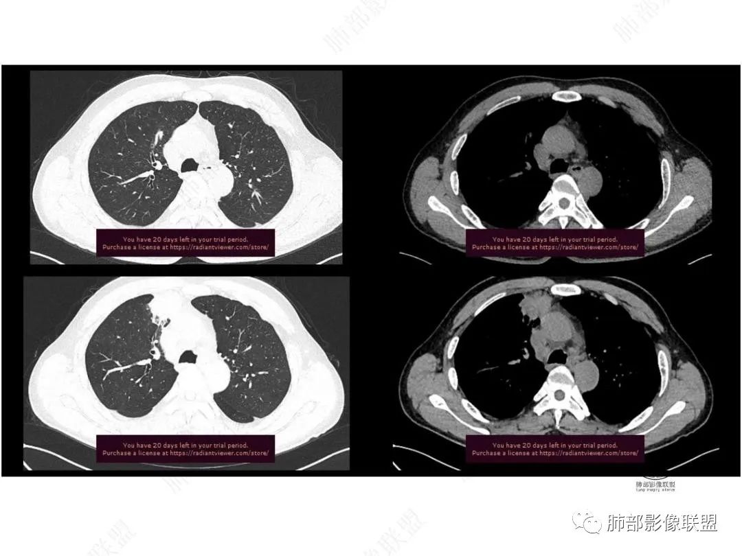 影像PPT - 【病例】右肺与肝脏病灶来袭,是否同源?-9 影像PPT - 【病例】右肺与肝脏病灶来袭,是否同源?-9