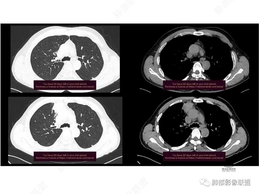 影像PPT - 【病例】右肺与肝脏病灶来袭,是否同源?-10 影像PPT - 【病例】右肺与肝脏病灶来袭,是否同源?-10