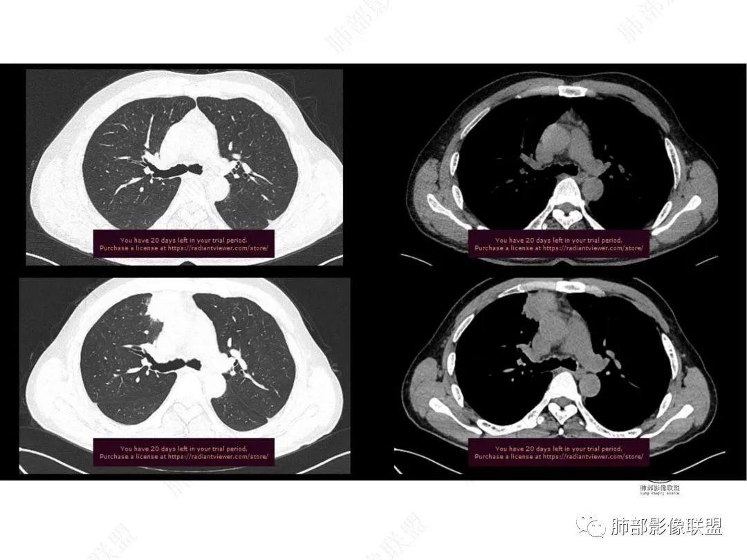 影像PPT - 【病例】右肺与肝脏病灶来袭,是否同源?-11 影像PPT - 【病例】右肺与肝脏病灶来袭,是否同源?-11