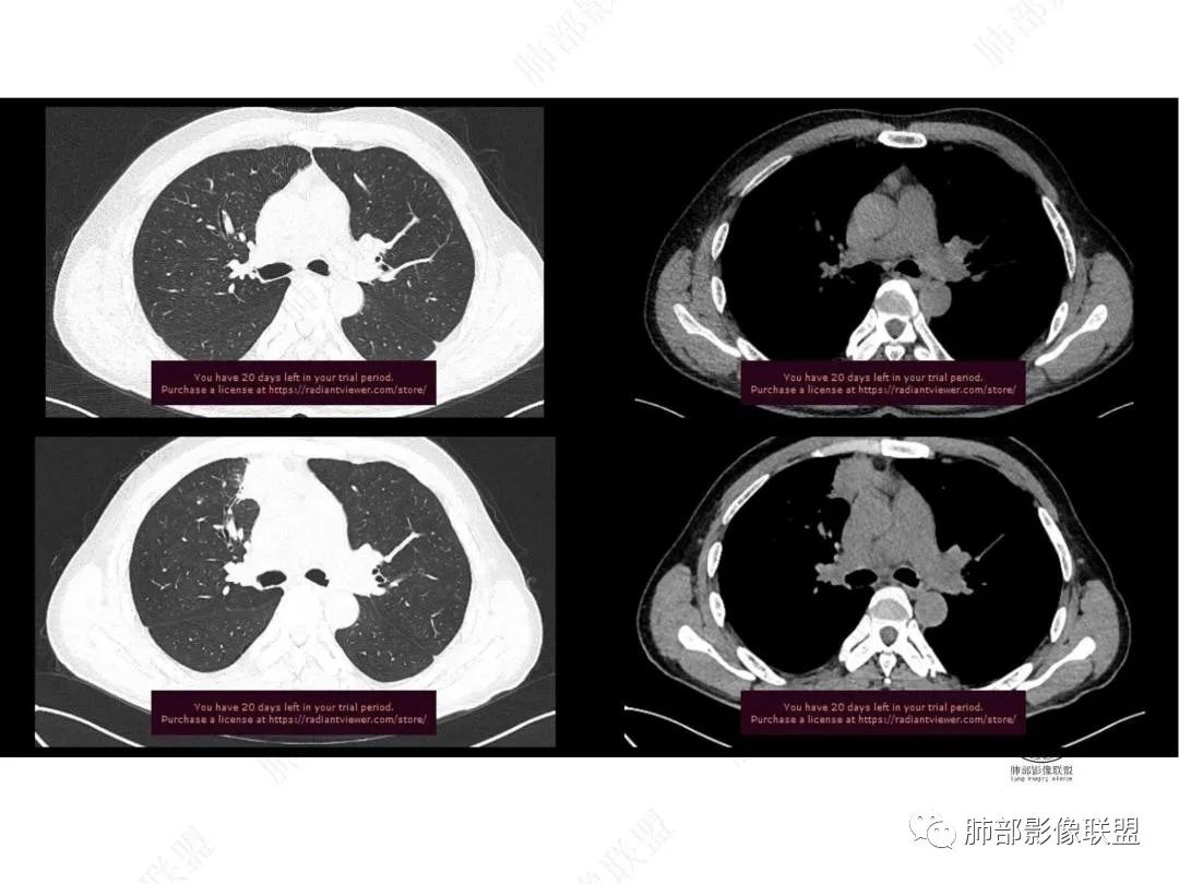 影像PPT - 【病例】右肺与肝脏病灶来袭,是否同源?-12 影像PPT - 【病例】右肺与肝脏病灶来袭,是否同源?-12