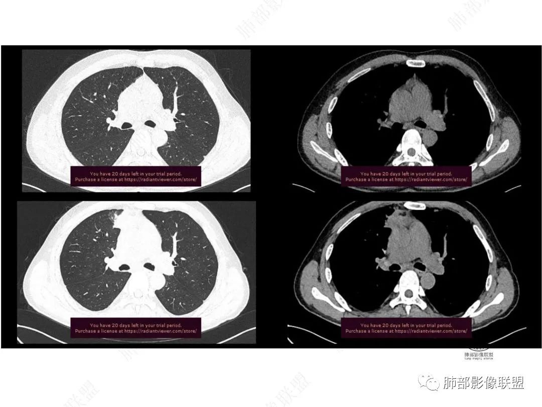 影像PPT - 【病例】右肺与肝脏病灶来袭,是否同源?-13 影像PPT - 【病例】右肺与肝脏病灶来袭,是否同源?-13