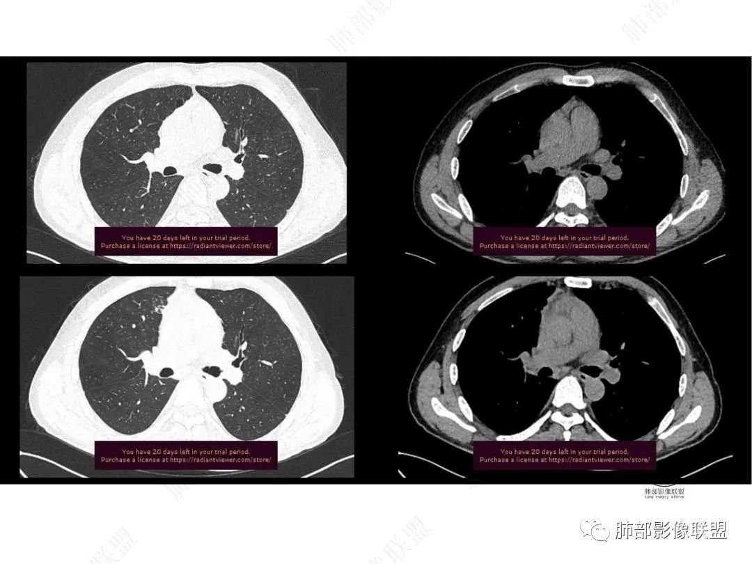 影像PPT - 【病例】右肺与肝脏病灶来袭,是否同源?-14 影像PPT - 【病例】右肺与肝脏病灶来袭,是否同源?-14
