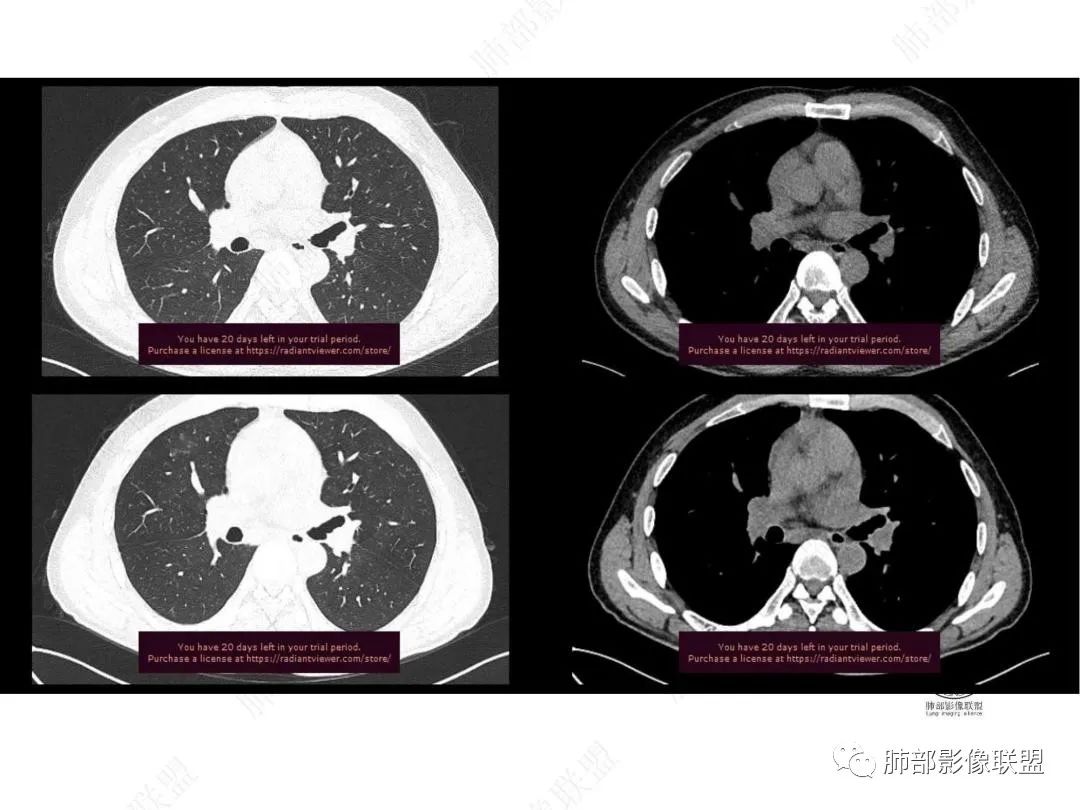 影像PPT - 【病例】右肺与肝脏病灶来袭,是否同源?-15 影像PPT - 【病例】右肺与肝脏病灶来袭,是否同源?-15