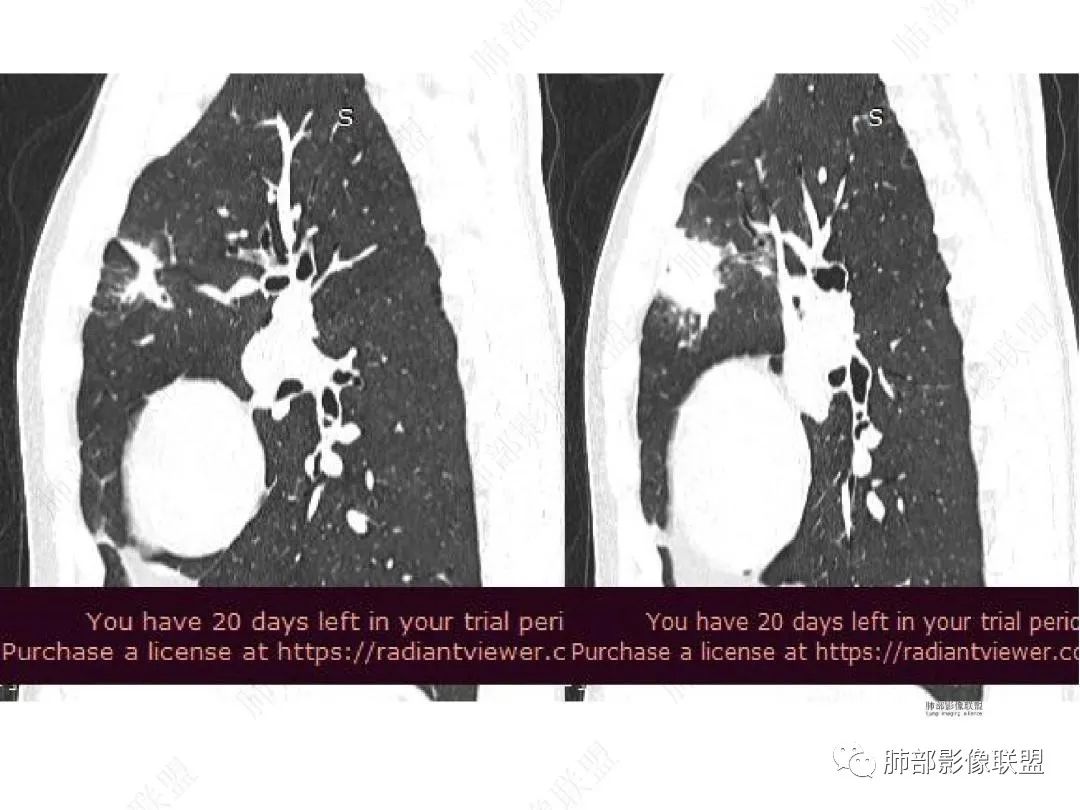 影像PPT - 【病例】右肺与肝脏病灶来袭,是否同源?-16 影像PPT - 【病例】右肺与肝脏病灶来袭,是否同源?-16