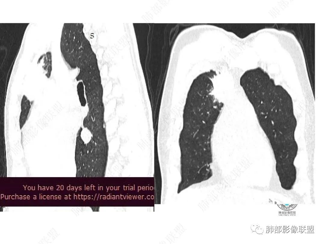 影像PPT - 【病例】右肺与肝脏病灶来袭,是否同源?-18 影像PPT - 【病例】右肺与肝脏病灶来袭,是否同源?-18