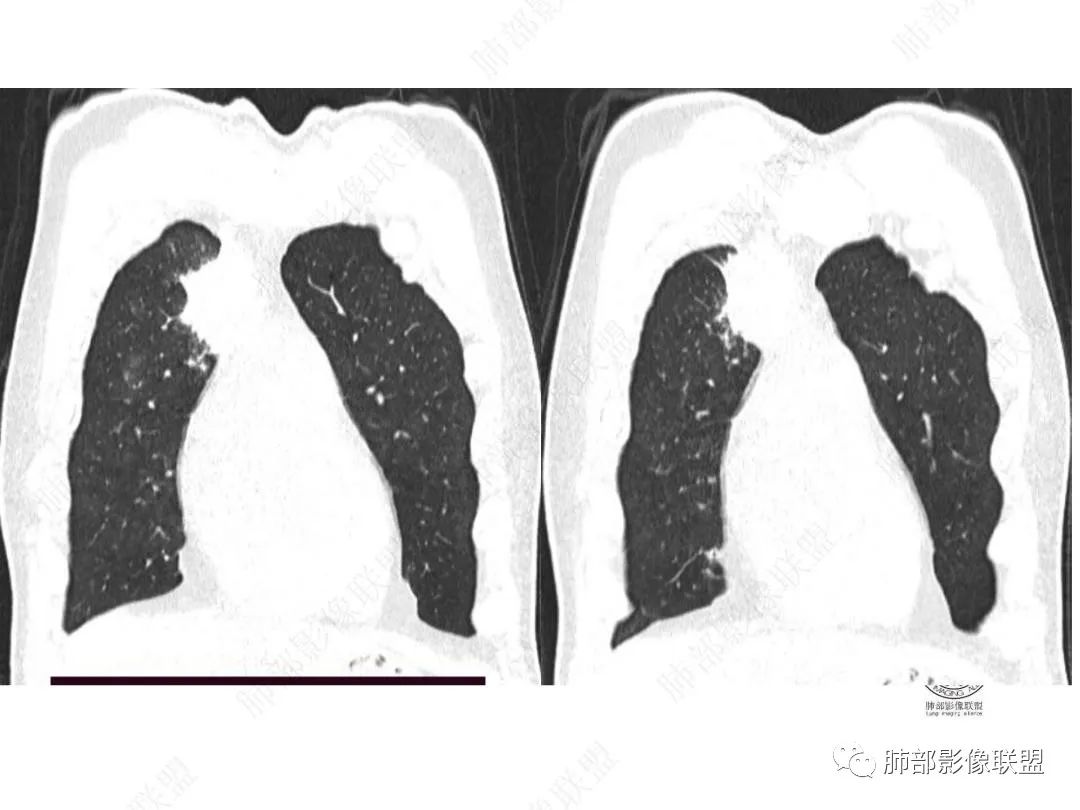 影像PPT - 【病例】右肺与肝脏病灶来袭,是否同源?-19 影像PPT - 【病例】右肺与肝脏病灶来袭,是否同源?-19