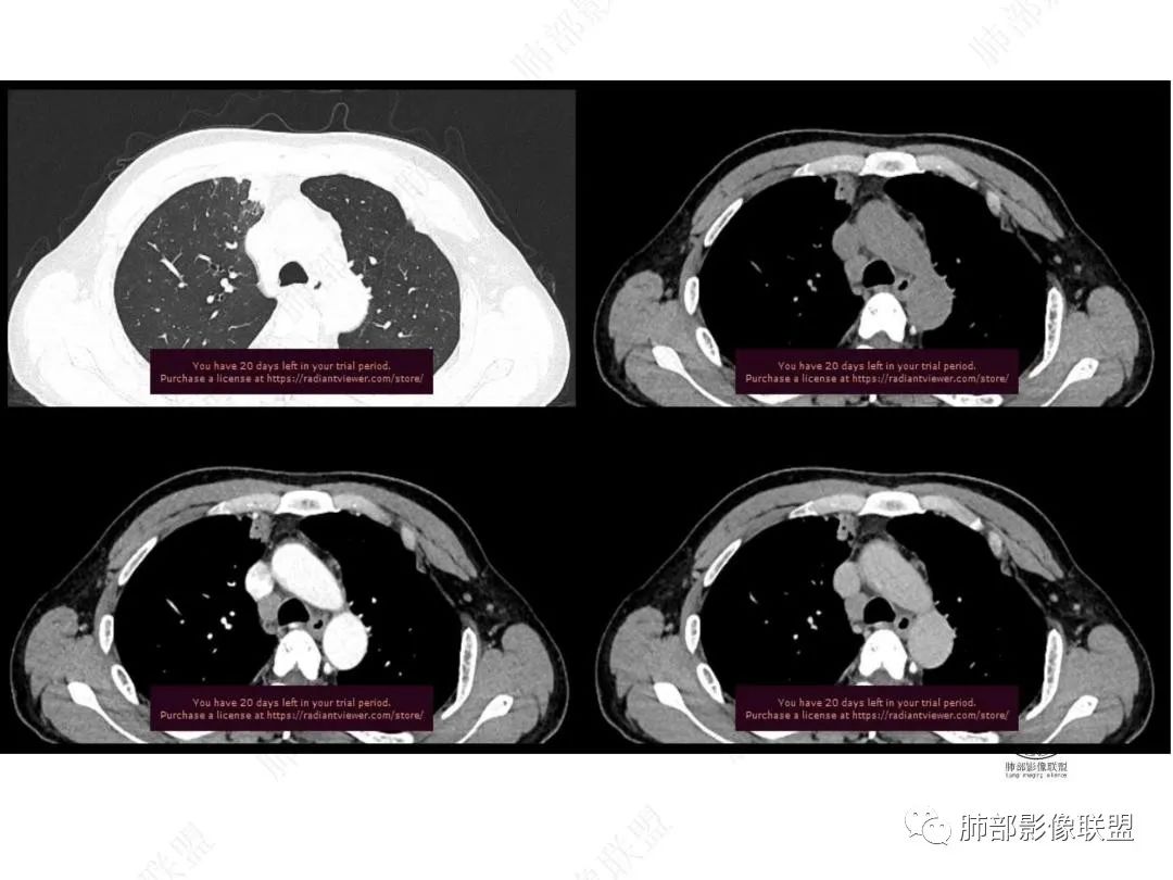 影像PPT - 【病例】右肺与肝脏病灶来袭,是否同源?-21 影像PPT - 【病例】右肺与肝脏病灶来袭,是否同源?-21
